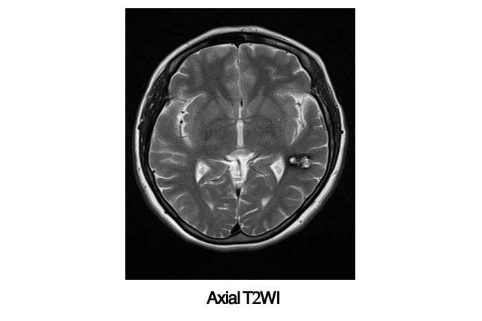 Epilepsy Axial T2WI